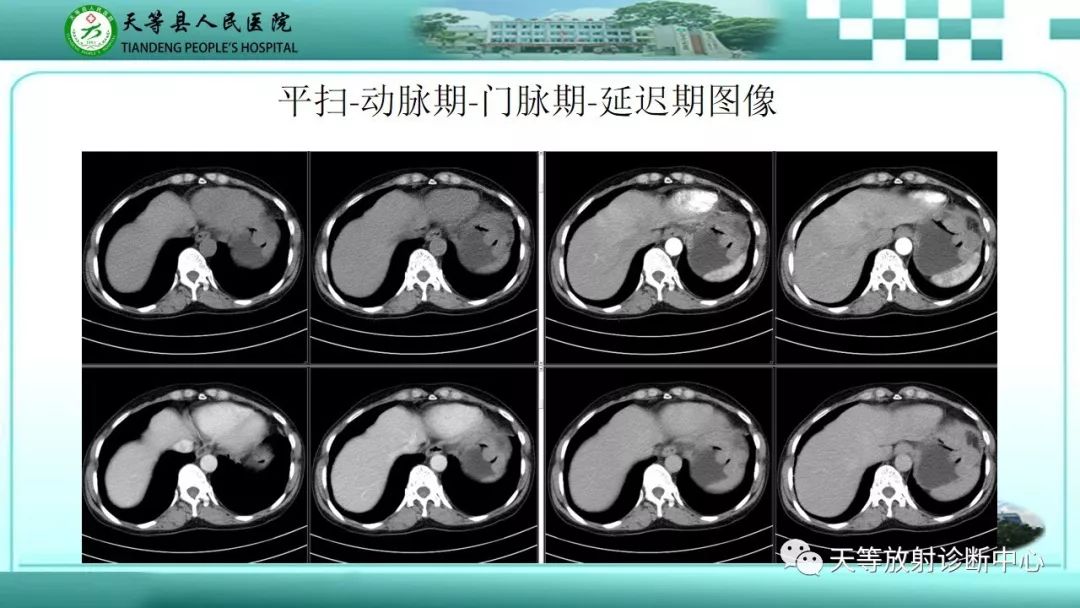 影像PPT - 【PPT】胃淋巴瘤-7