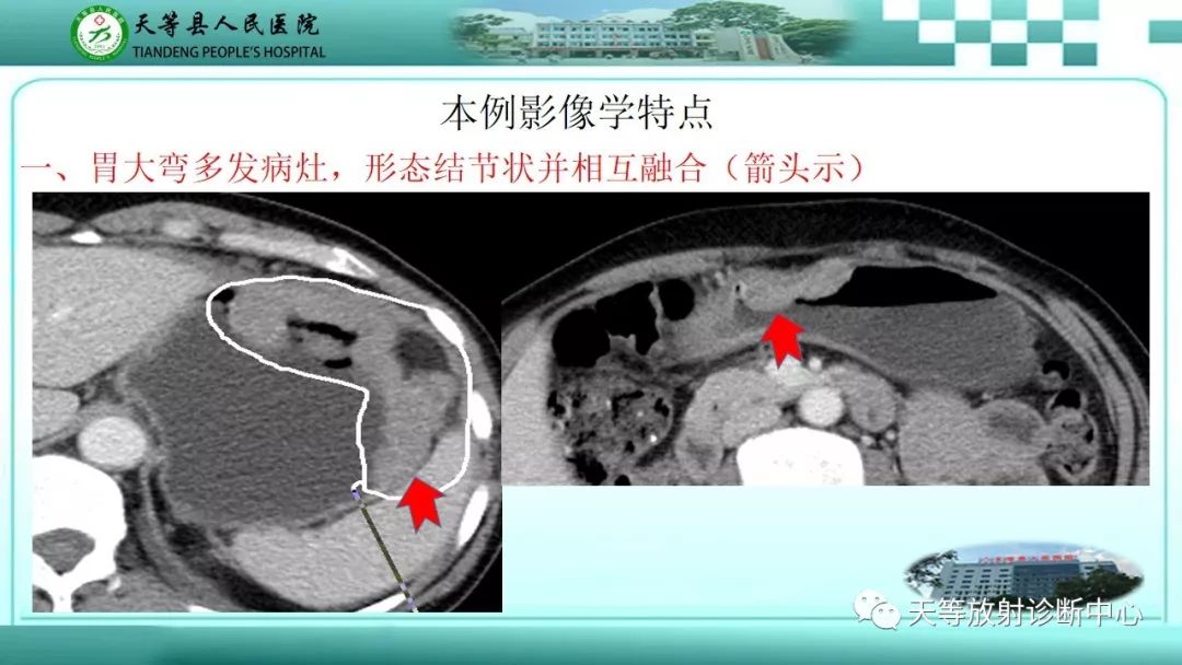 影像PPT - 【PPT】胃淋巴瘤-17
