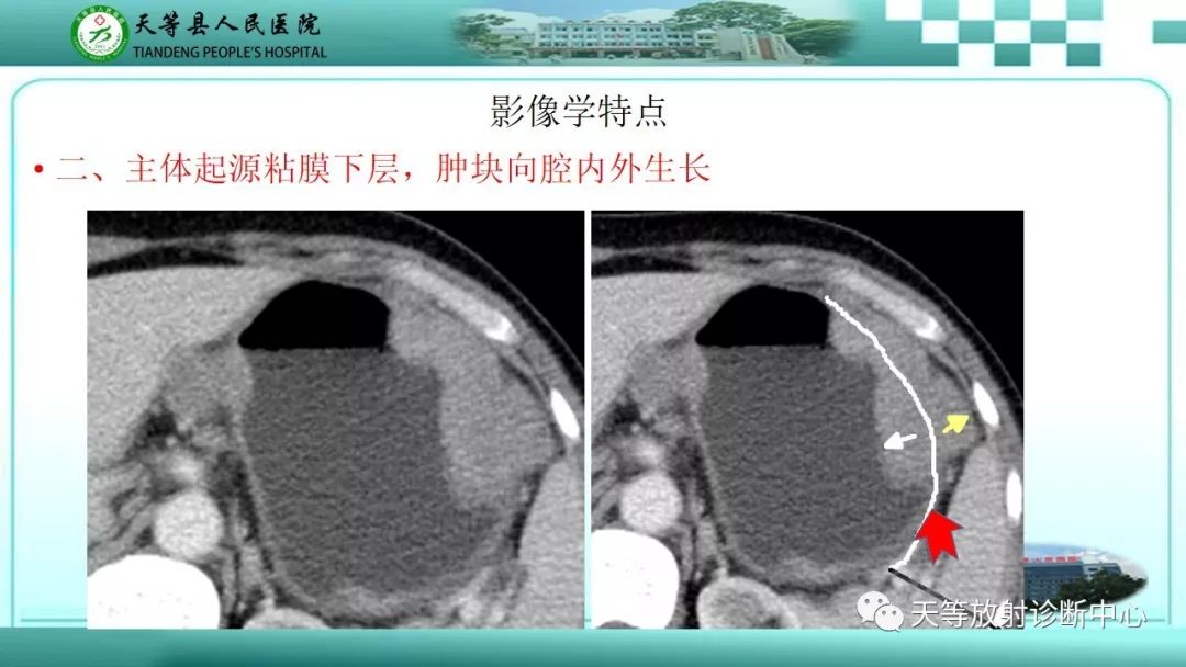 影像PPT - 【PPT】胃淋巴瘤-18