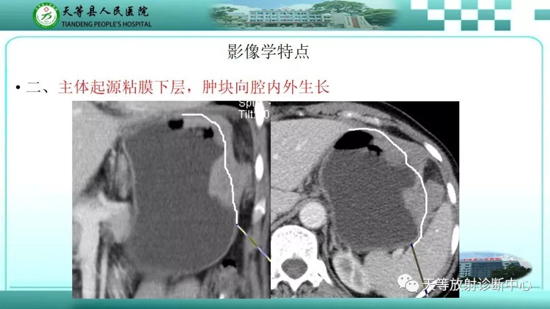 影像PPT - 【PPT】胃淋巴瘤-19