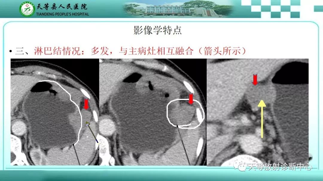 影像PPT - 【PPT】胃淋巴瘤-20
