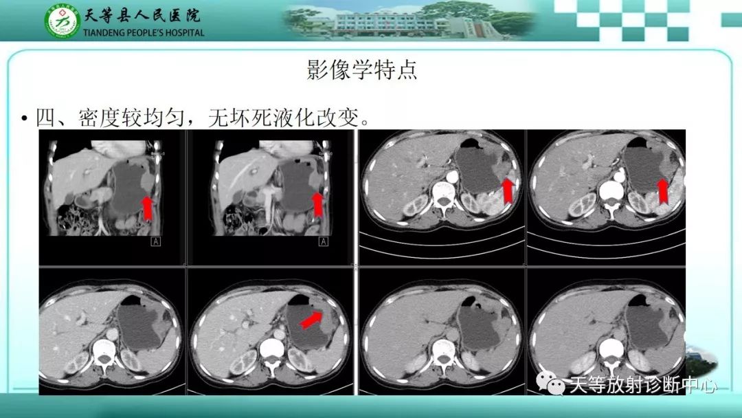影像PPT - 【PPT】胃淋巴瘤-21