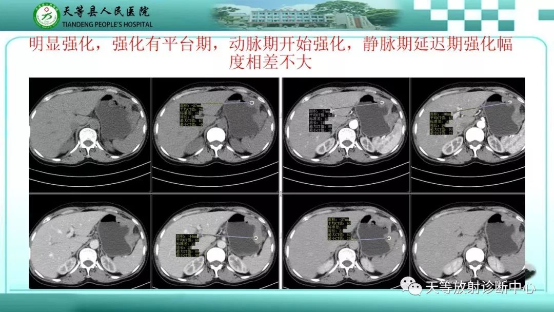 影像PPT - 【PPT】胃淋巴瘤-23
