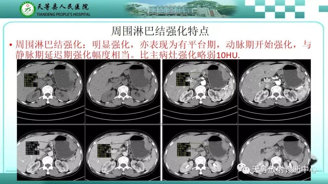 影像PPT - 【PPT】胃淋巴瘤-24