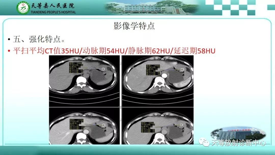 影像PPT - 【PPT】胃淋巴瘤-22