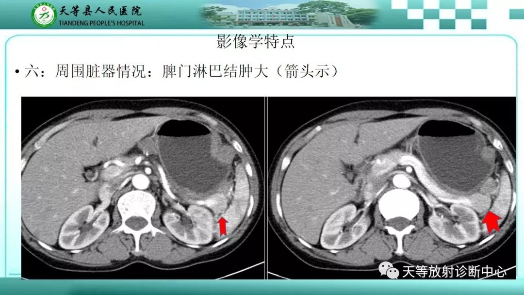 影像PPT - 【PPT】胃淋巴瘤-25