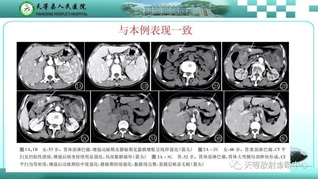 影像PPT - 【PPT】胃淋巴瘤-33