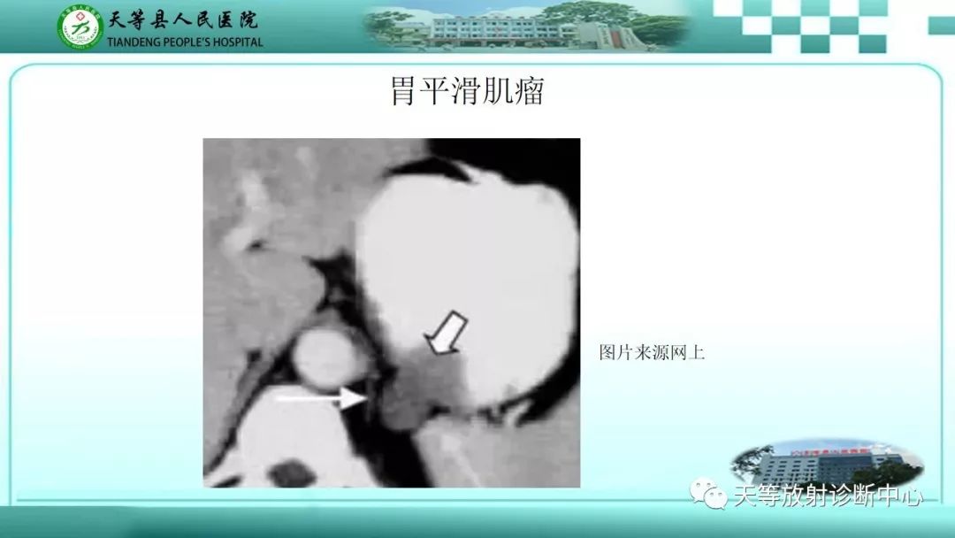 影像PPT - 【PPT】胃淋巴瘤-37