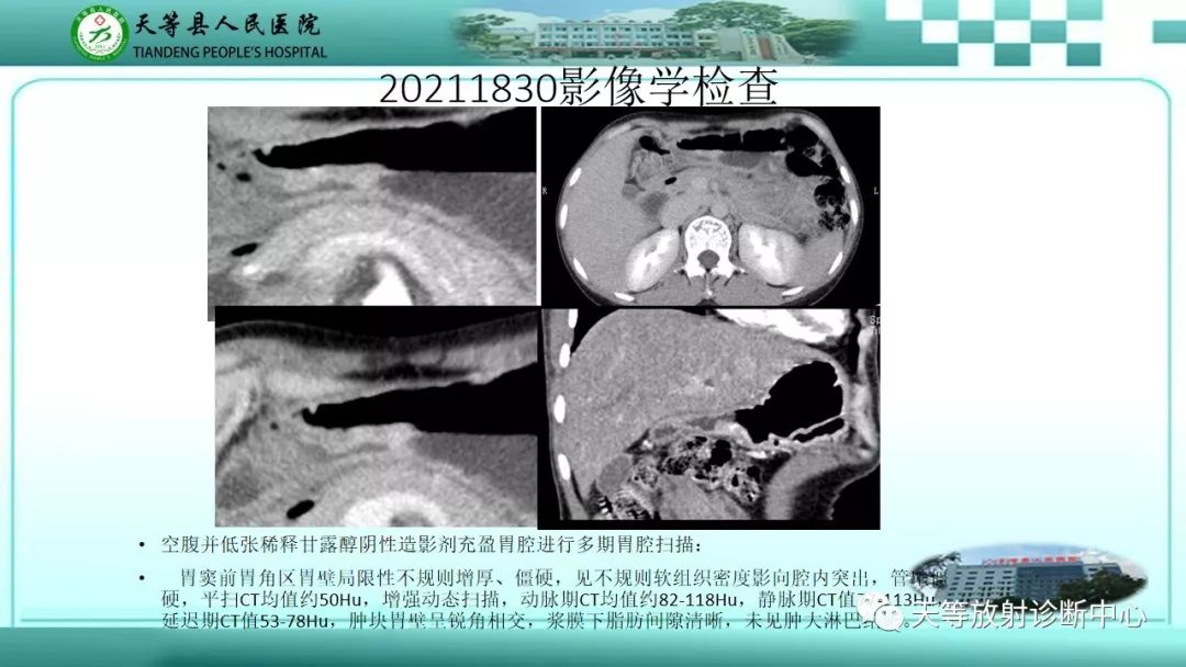 影像PPT - 【PPT】胃淋巴瘤-43