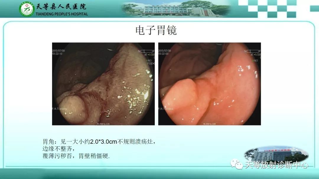 影像PPT - 【PPT】胃淋巴瘤-44