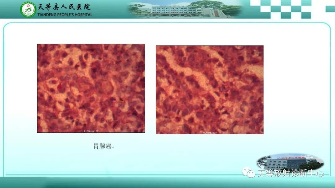 影像PPT - 【PPT】胃淋巴瘤-45