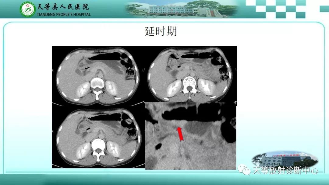 影像PPT - 【PPT】胃淋巴瘤-41