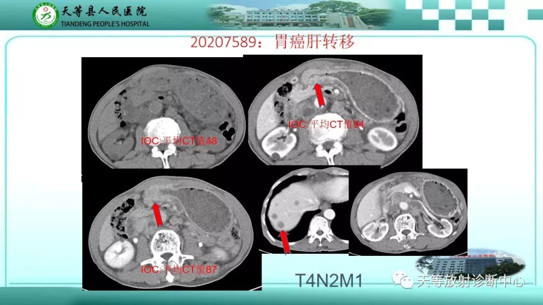 影像PPT - 【PPT】胃淋巴瘤-47