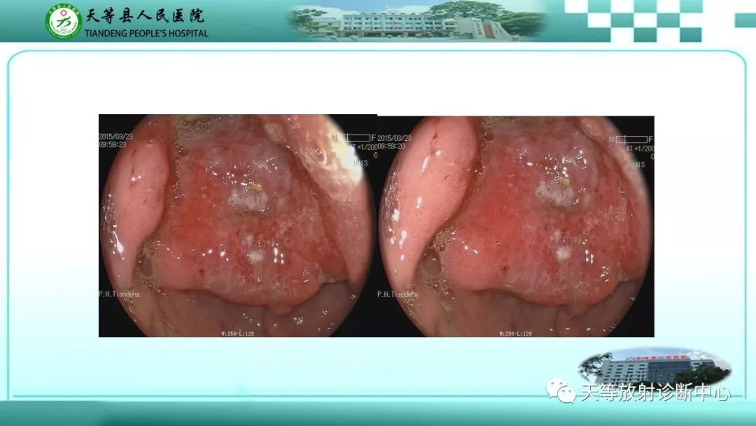 影像PPT - 【PPT】胃淋巴瘤-48