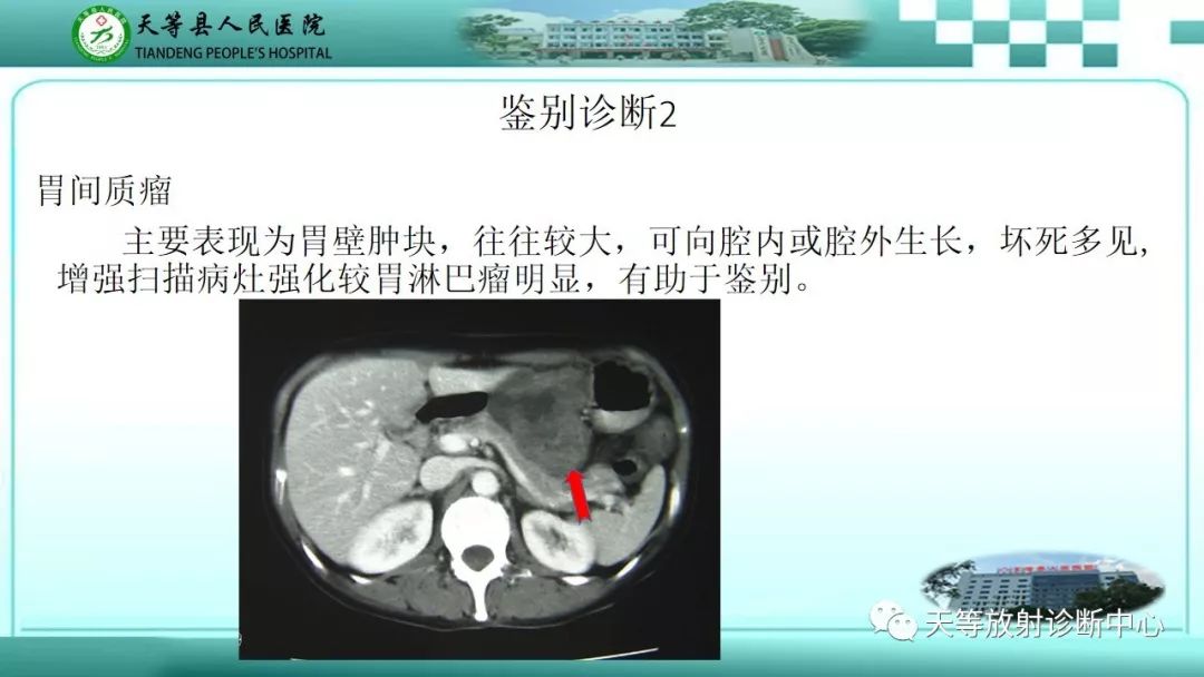 影像PPT - 【PPT】胃淋巴瘤-50
