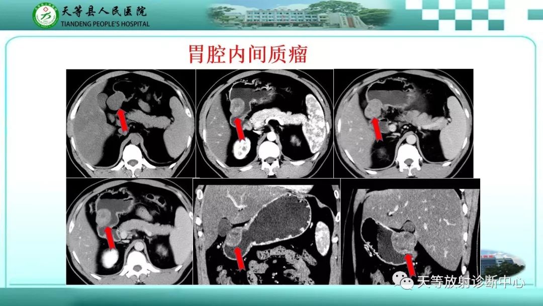 影像PPT - 【PPT】胃淋巴瘤-52