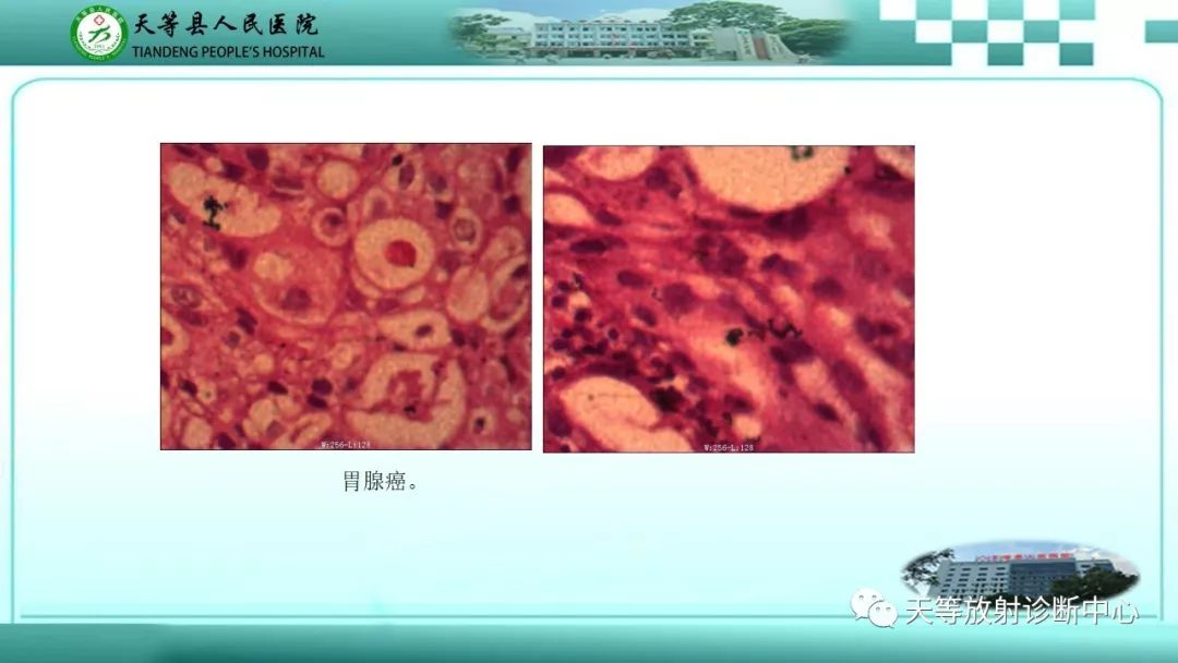 影像PPT - 【PPT】胃淋巴瘤-49