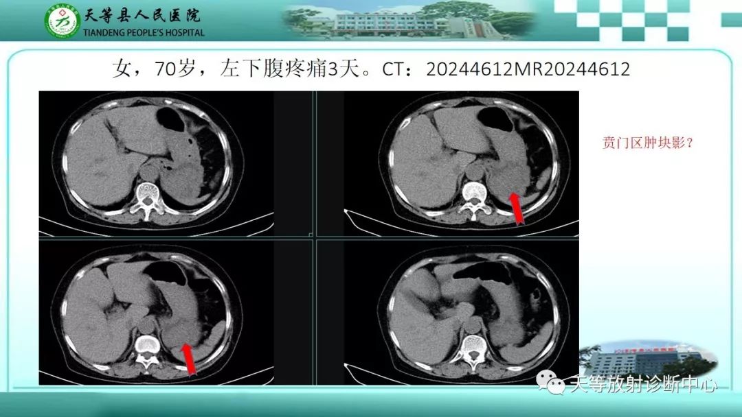 影像PPT - 【PPT】胃淋巴瘤-54