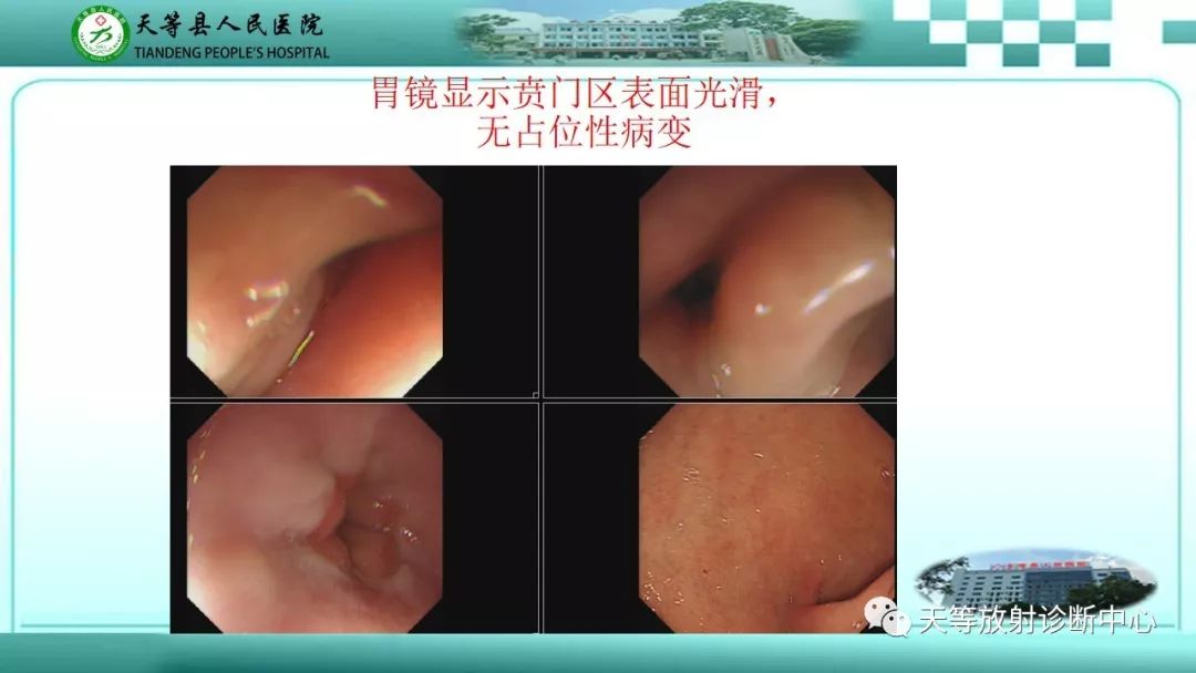 影像PPT - 【PPT】胃淋巴瘤-56