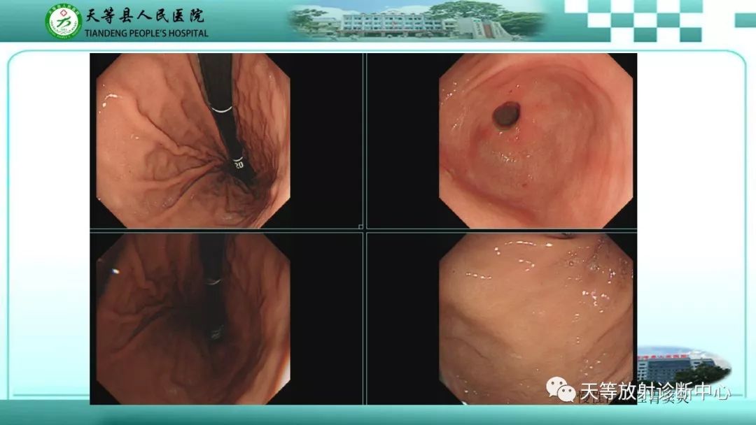 影像PPT - 【PPT】胃淋巴瘤-57