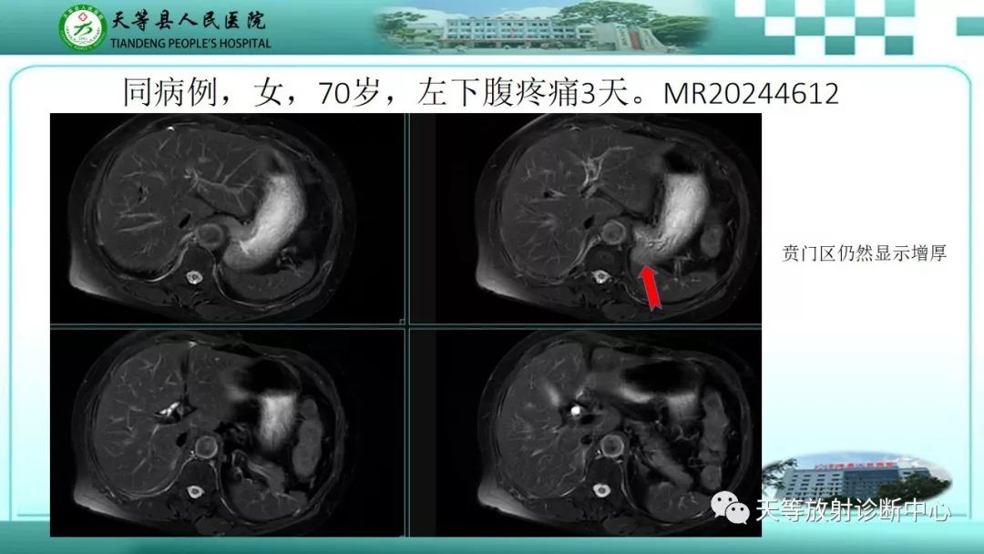 影像PPT - 【PPT】胃淋巴瘤-58