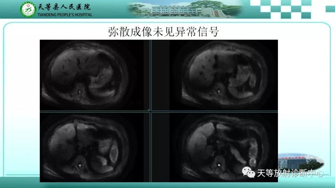 影像PPT - 【PPT】胃淋巴瘤-61
