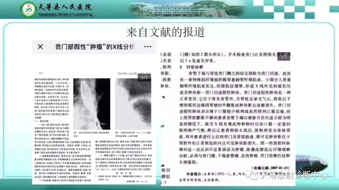 影像PPT - 【PPT】胃淋巴瘤-62