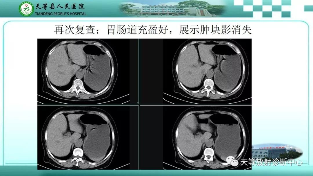 影像PPT - 【PPT】胃淋巴瘤-63