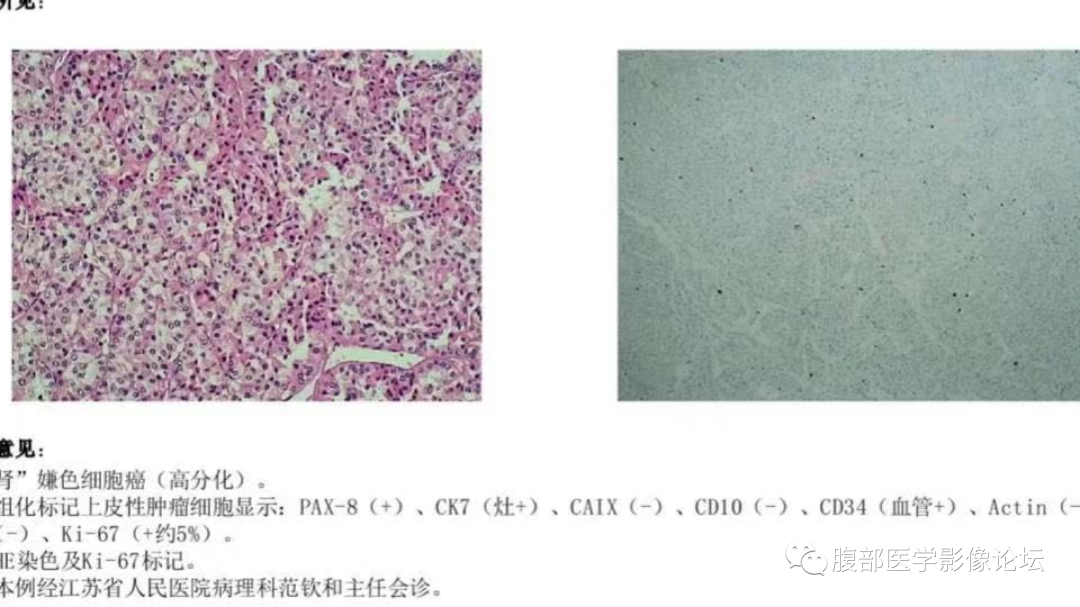 影像PPT - 【病例】肾脏嫌色细胞癌1例CT影像-8