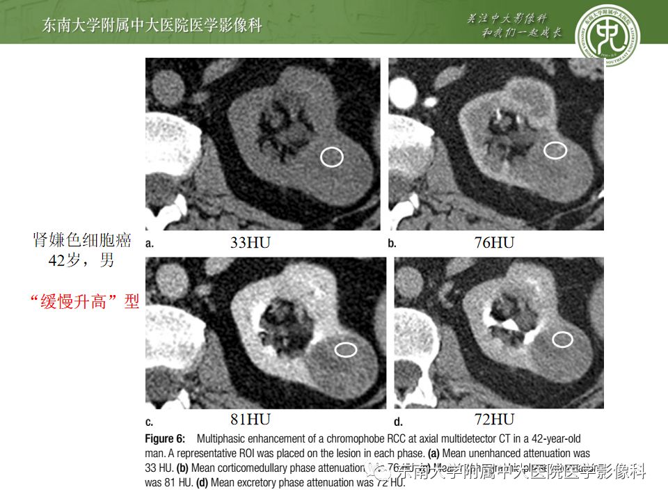 影像PPT - 【病例】肾脏嫌色细胞癌1例CT影像-13