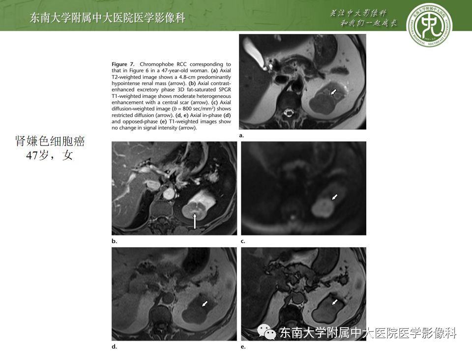 影像PPT - 【病例】肾脏嫌色细胞癌1例CT影像-14