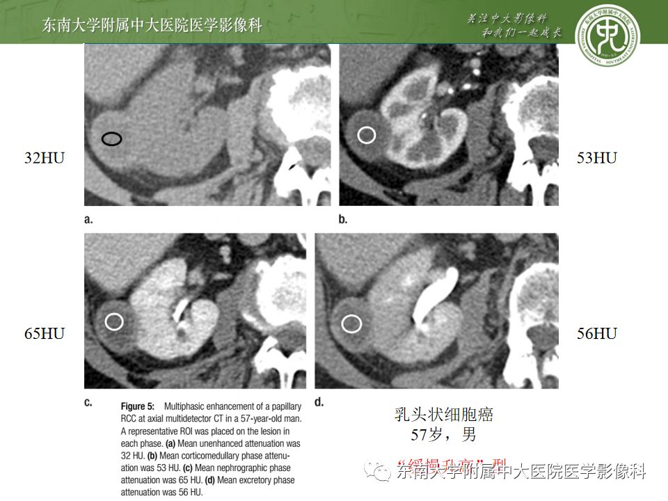 影像PPT - 【病例】肾脏嫌色细胞癌1例CT影像-16
