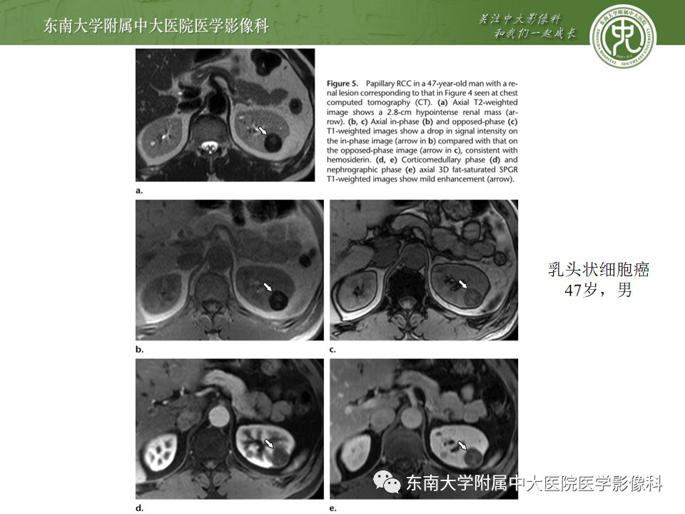 影像PPT - 【病例】肾脏嫌色细胞癌1例CT影像-17