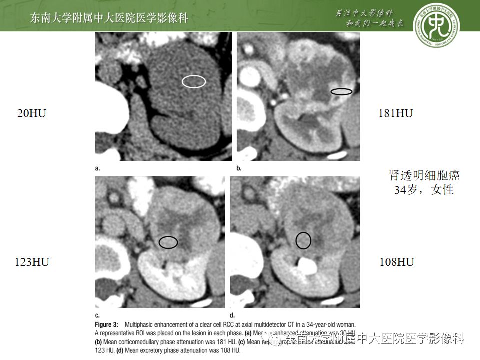 影像PPT - 【病例】肾脏嫌色细胞癌1例CT影像-18
