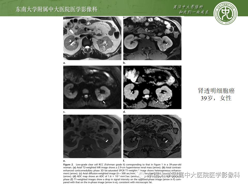 影像PPT - 【病例】肾脏嫌色细胞癌1例CT影像-19