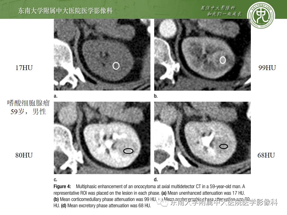 影像PPT - 【病例】肾脏嫌色细胞癌1例CT影像-21