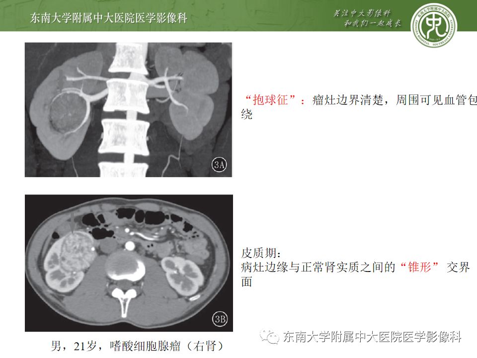 影像PPT - 【病例】肾脏嫌色细胞癌1例CT影像-23