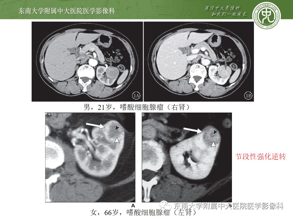 影像PPT - 【病例】肾脏嫌色细胞癌1例CT影像-22