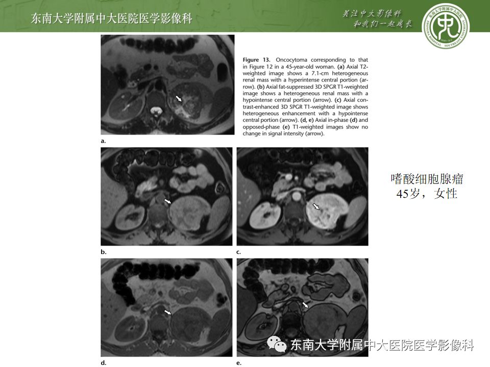 影像PPT - 【病例】肾脏嫌色细胞癌1例CT影像-24