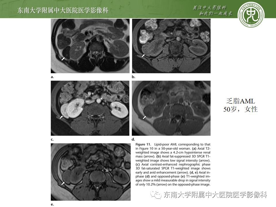 影像PPT - 【病例】肾脏嫌色细胞癌1例CT影像-26