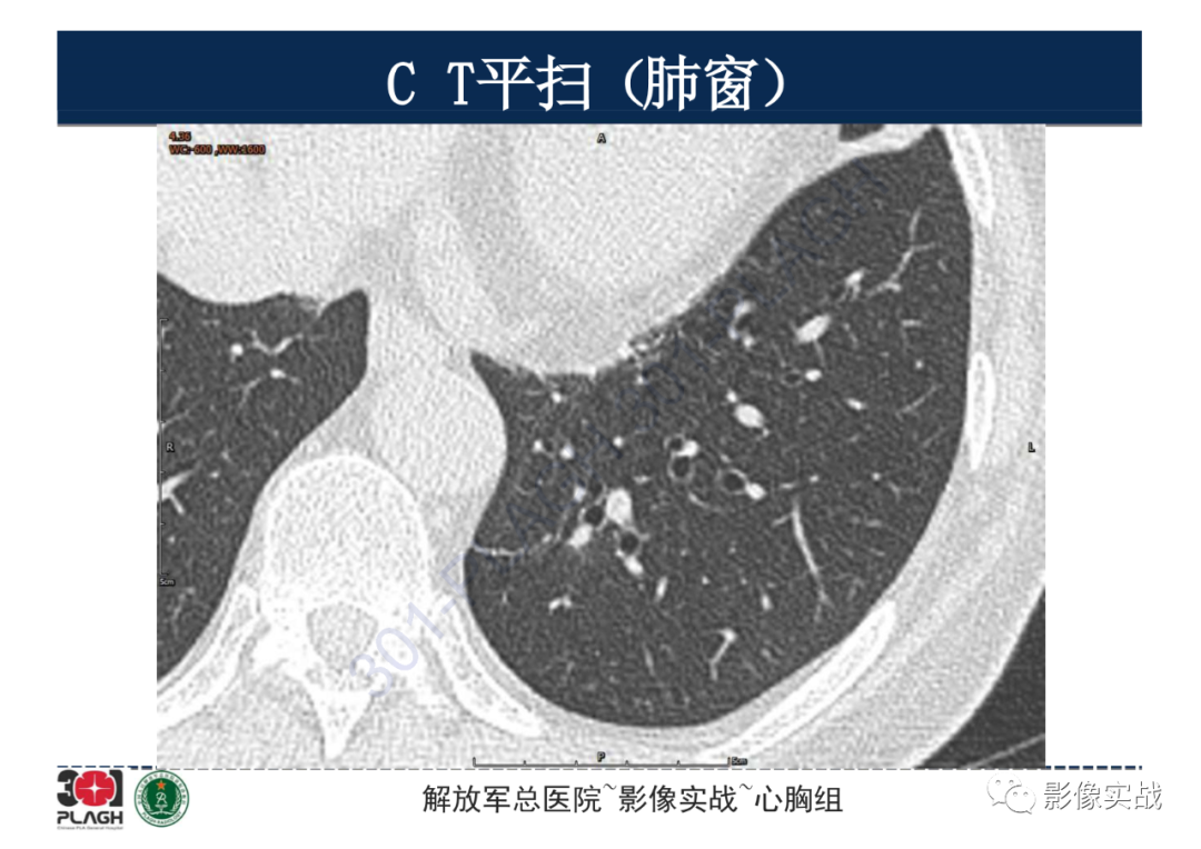 影像PPT - 【病例】肺浸润性腺癌1例CT影像-3