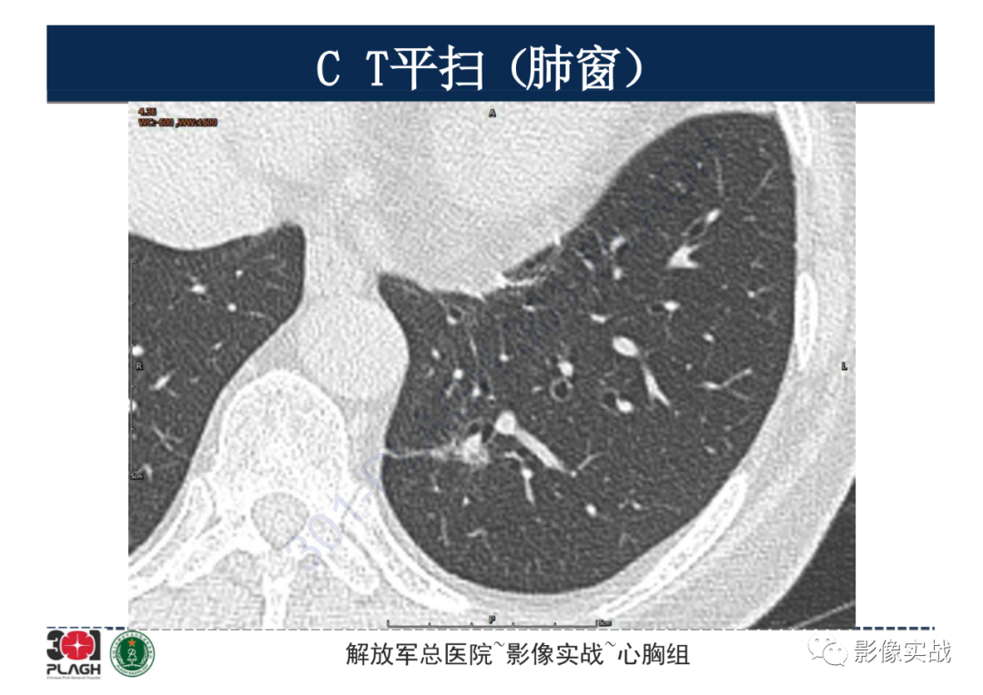 影像PPT - 【病例】肺浸润性腺癌1例CT影像-4