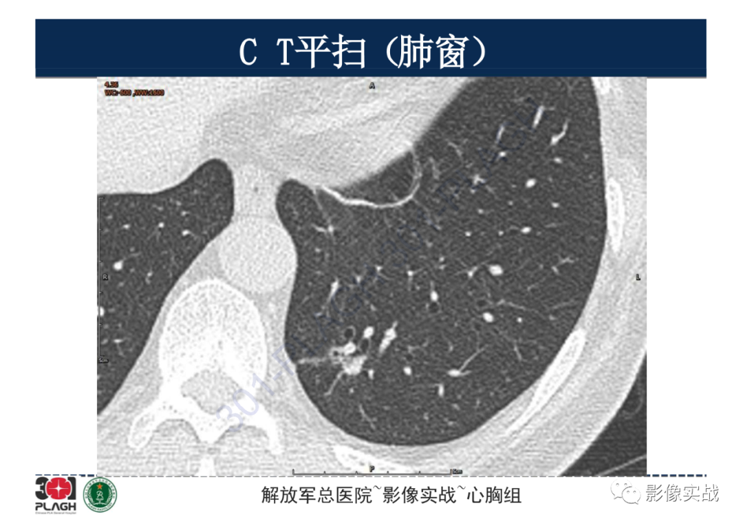 影像PPT - 【病例】肺浸润性腺癌1例CT影像-7