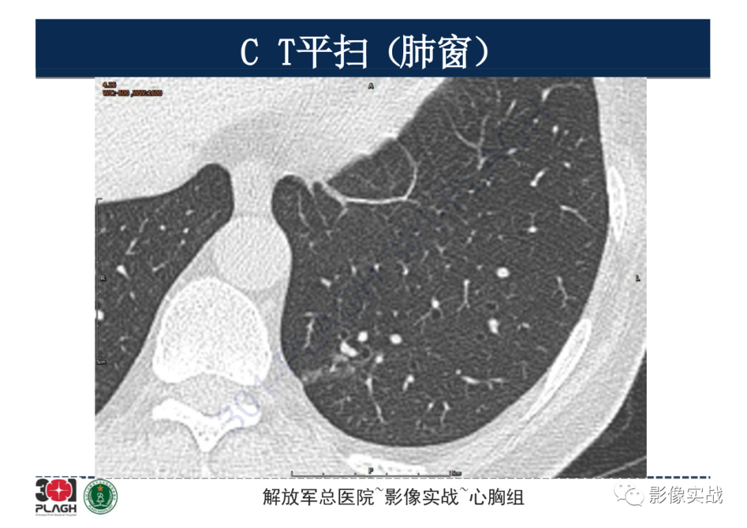影像PPT - 【病例】肺浸润性腺癌1例CT影像-8