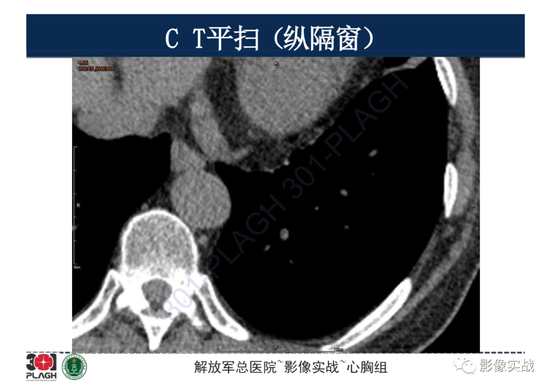 影像PPT - 【病例】肺浸润性腺癌1例CT影像-9
