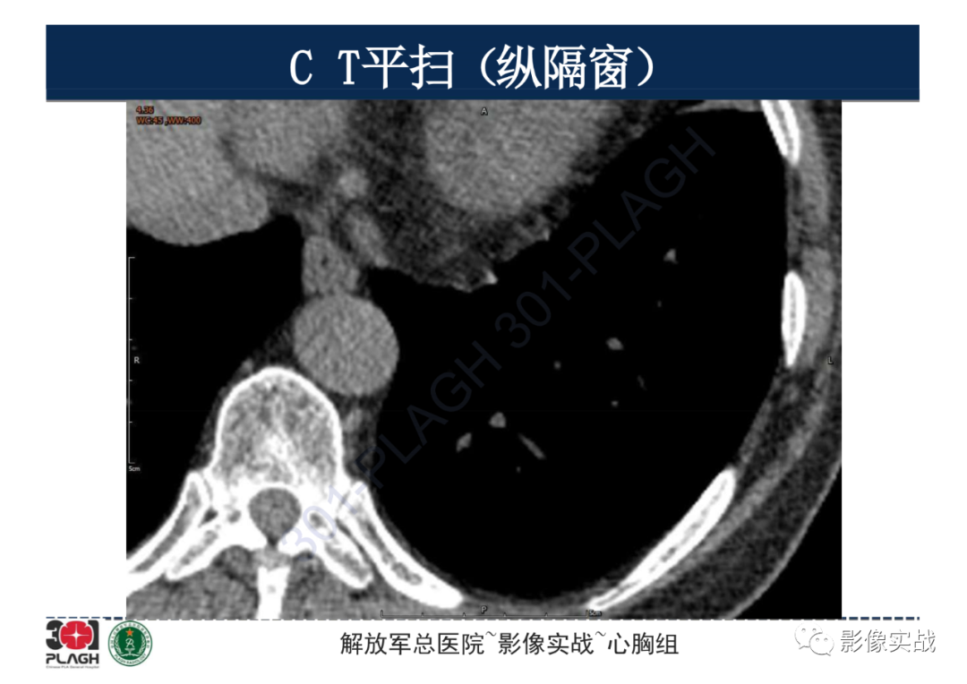 影像PPT - 【病例】肺浸润性腺癌1例CT影像-10