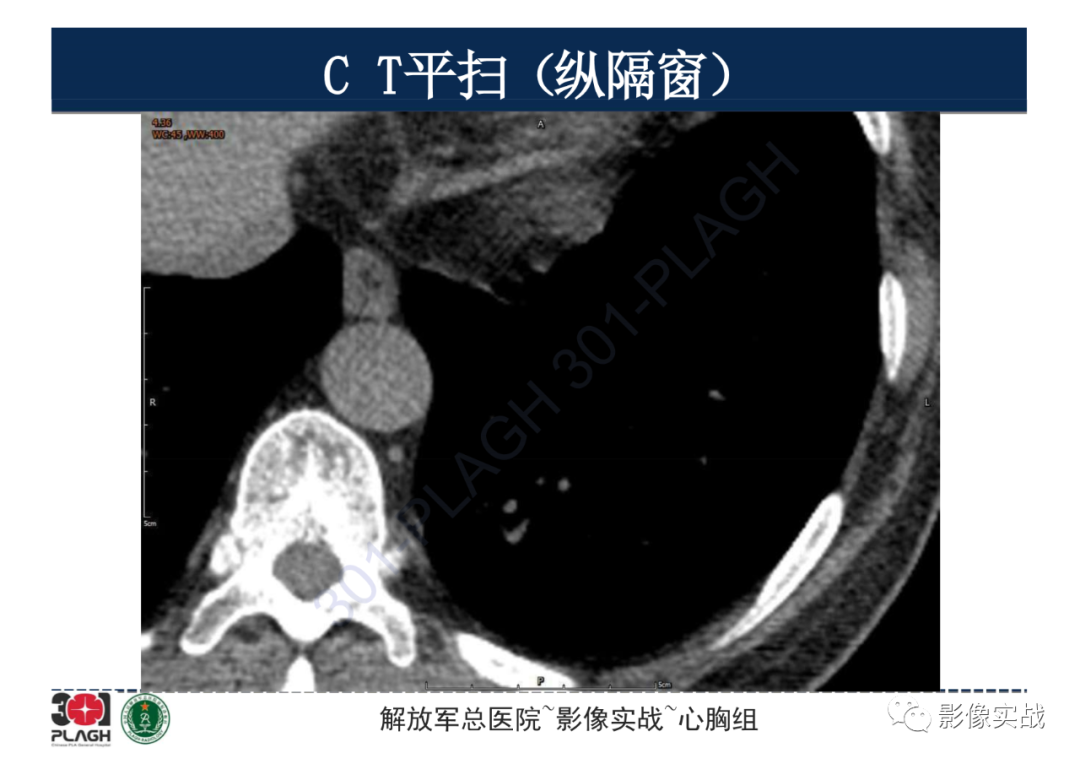 影像PPT - 【病例】肺浸润性腺癌1例CT影像-12