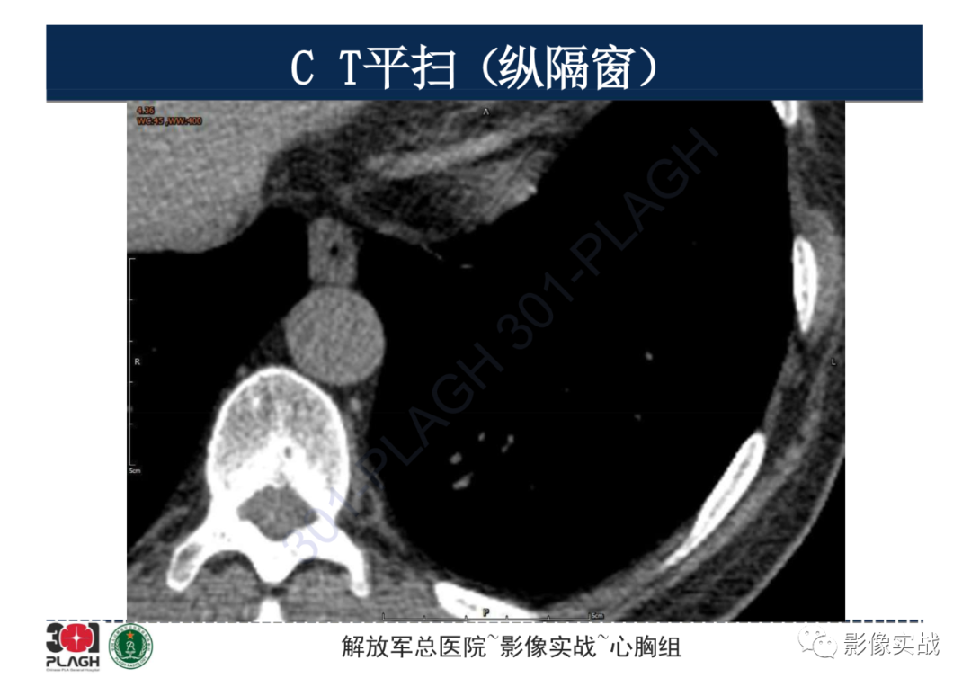 影像PPT - 【病例】肺浸润性腺癌1例CT影像-13