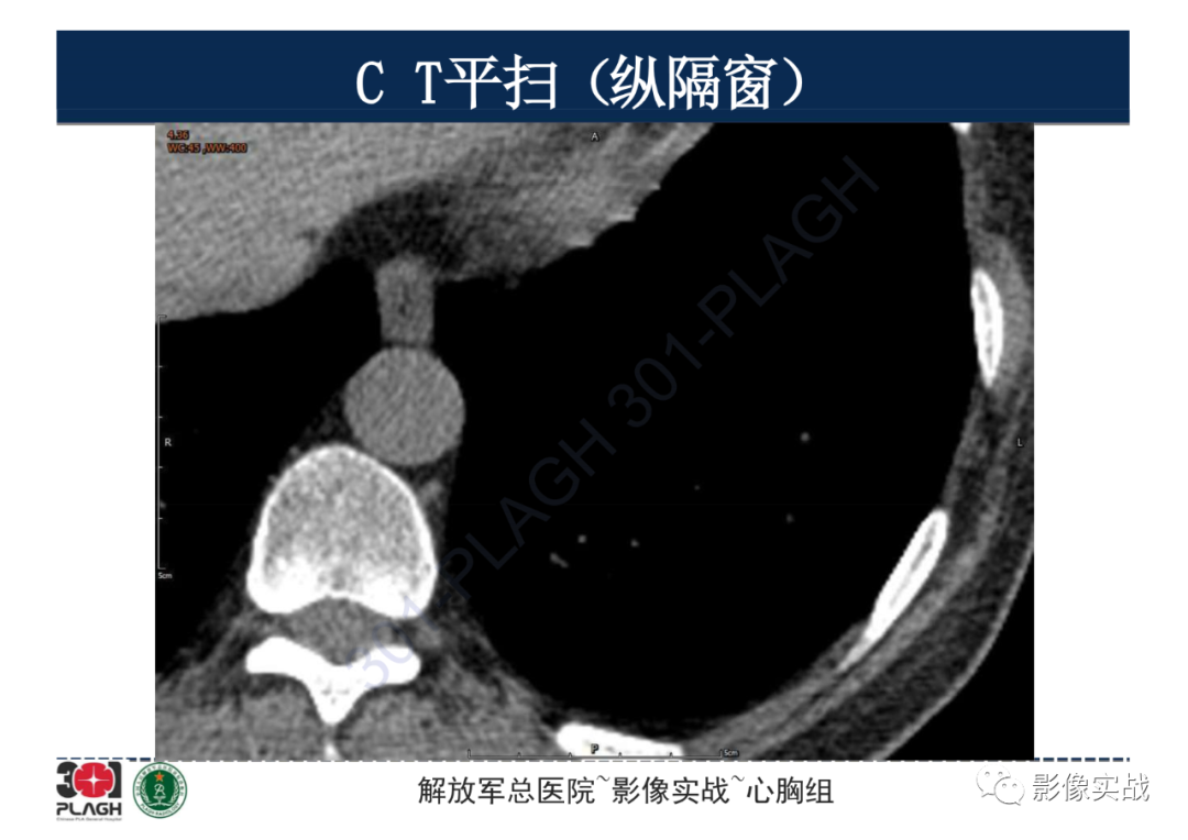 影像PPT - 【病例】肺浸润性腺癌1例CT影像-14
