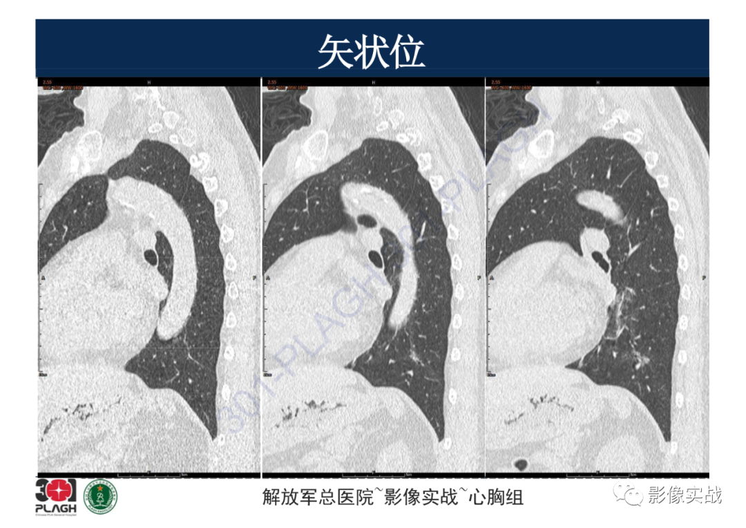 影像PPT - 【病例】肺浸润性腺癌1例CT影像-15